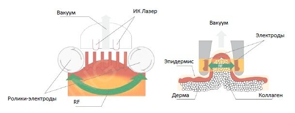 Cellulite_Wrinkle_Removal_RF_Vacuum_Slimming_System_schema